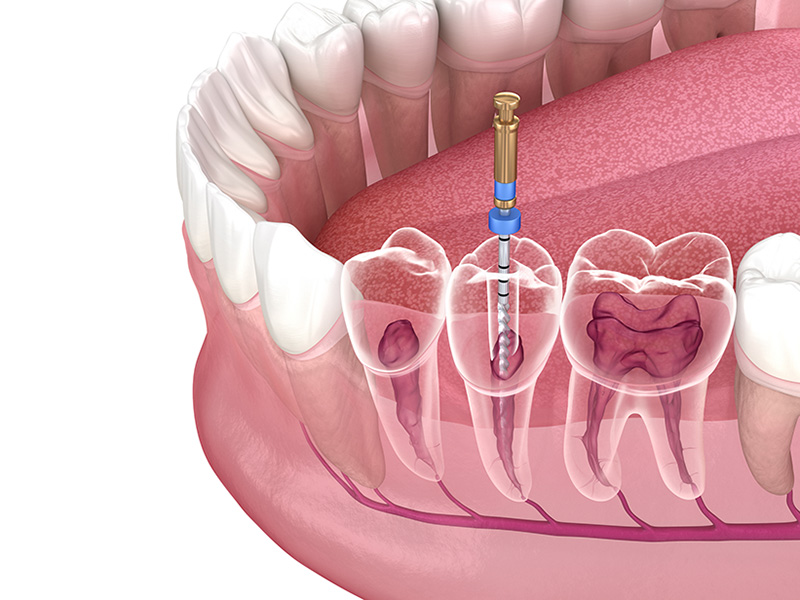 klinik gigi root canal treatment